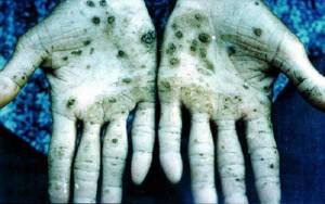 Signs of poisoning on the hands of an arsenic miner.